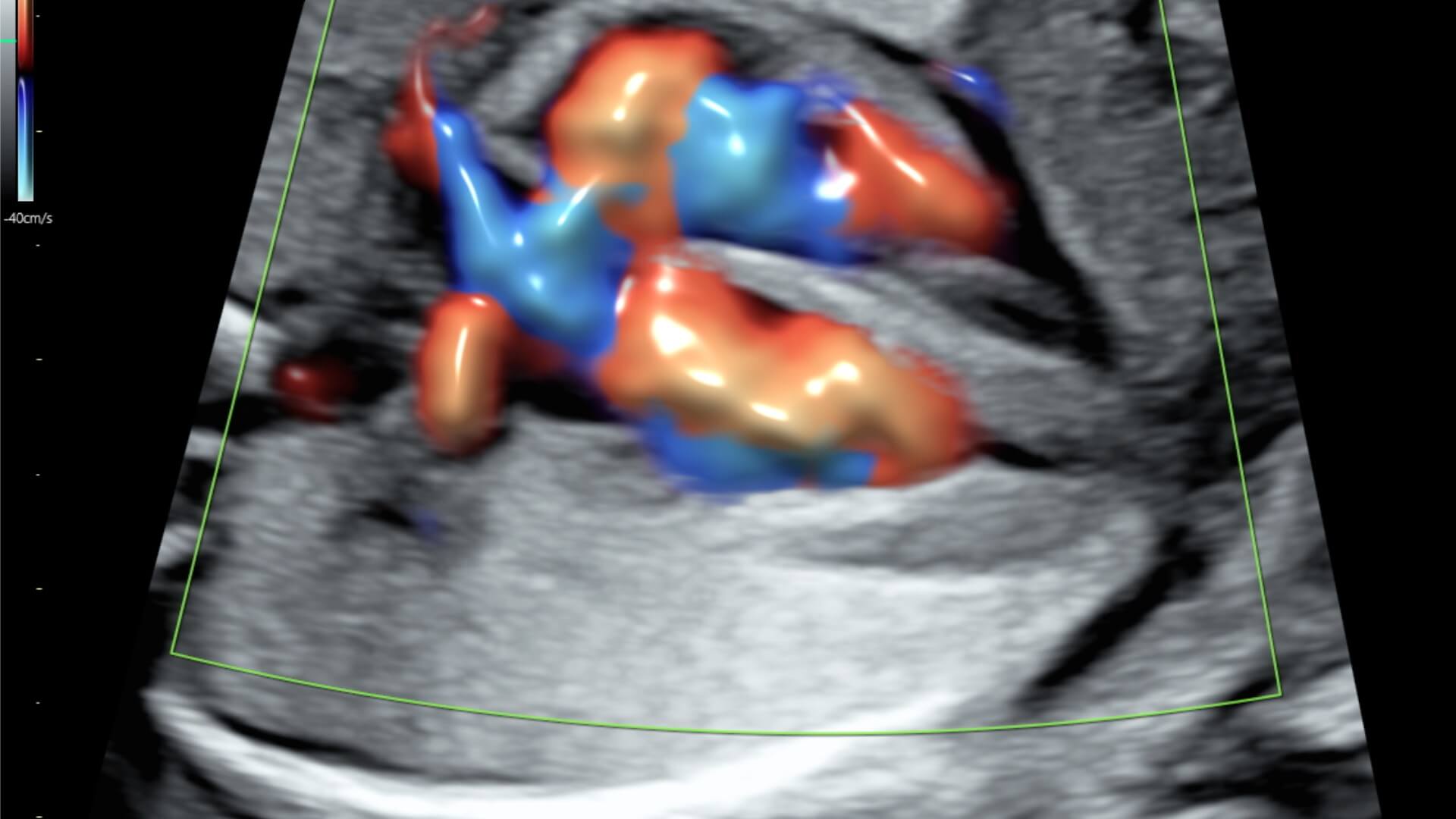 Ecocardiografía Fetal - Medicina Fetal Perú
